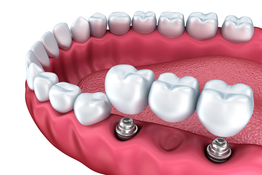 implantes dentales Terrassa
