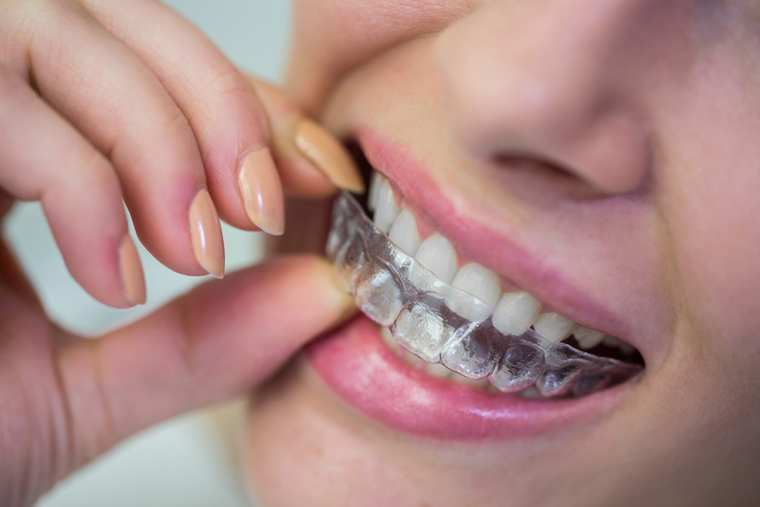 Invisalign en Terrassa