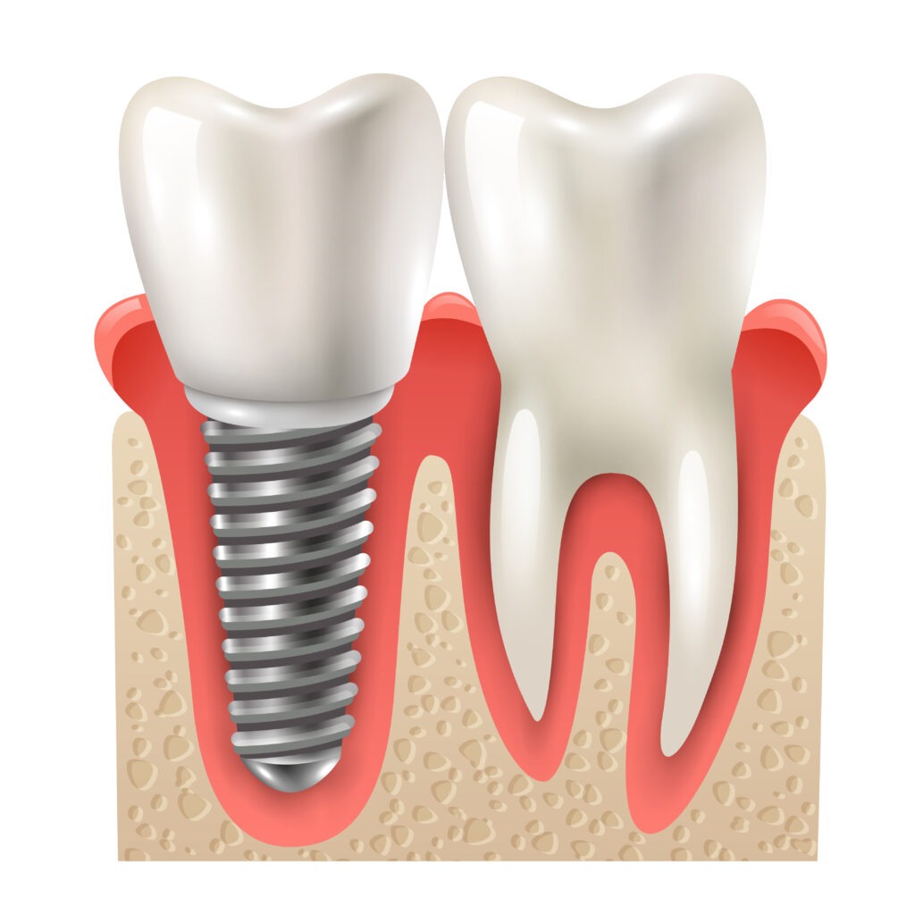 tiempo implante dental
