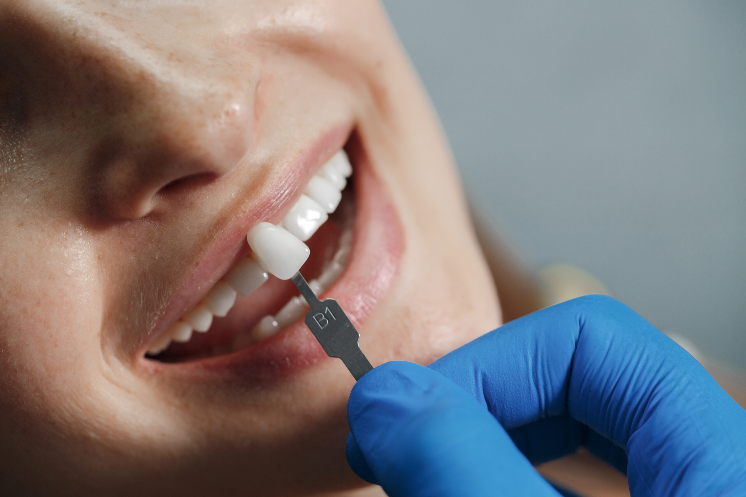 implante dental después de perder un diente