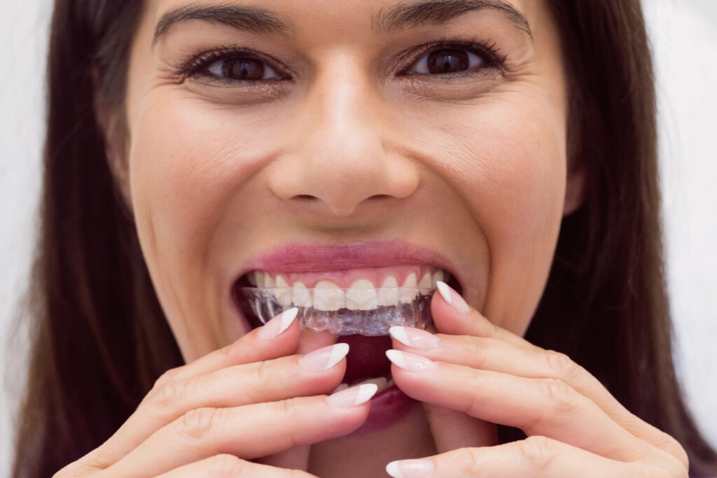 invisalign o brackets