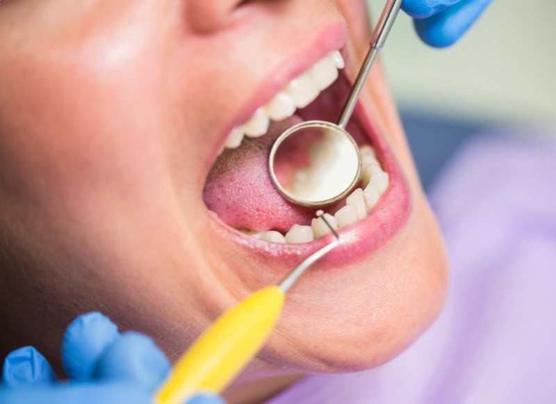 periodontitis avanzada