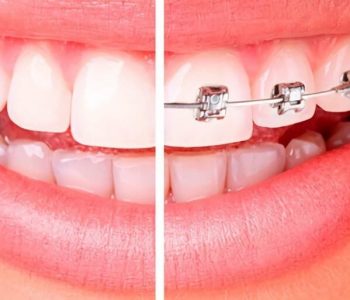 7-fases-ortodoncia-822x513