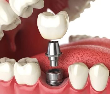 como-cuidar-implantes-dentales
