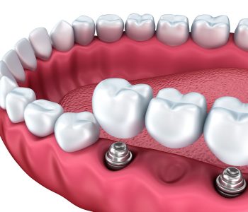implantes dentales Terrassa